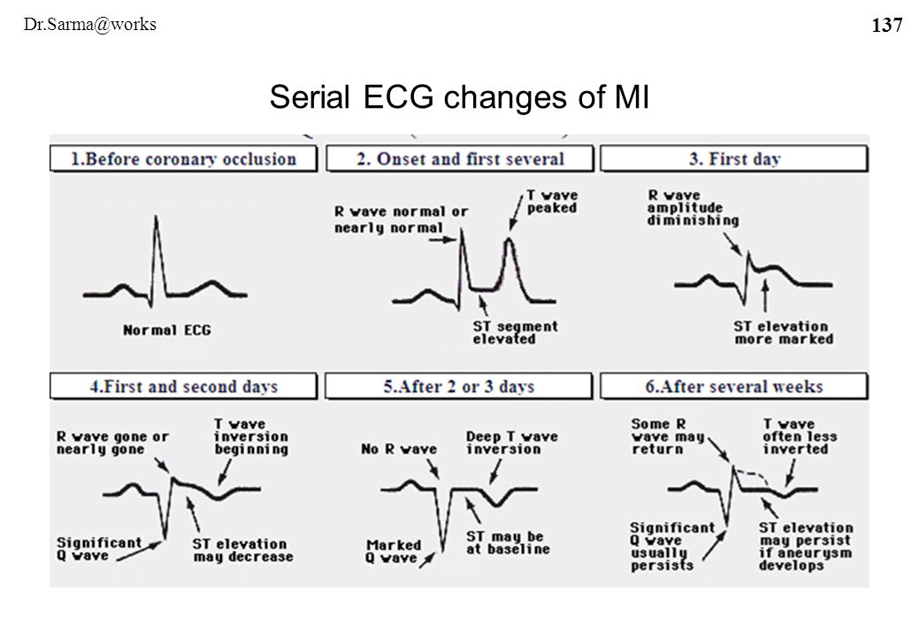 Ecg In Left Ventricular Hypertrophy Lvh Criteria And Off